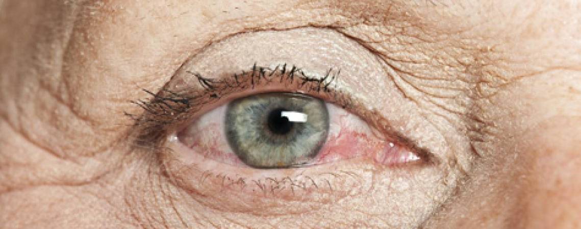 Consejos farmacéuticos para mejorar el síndrome de ojos secos