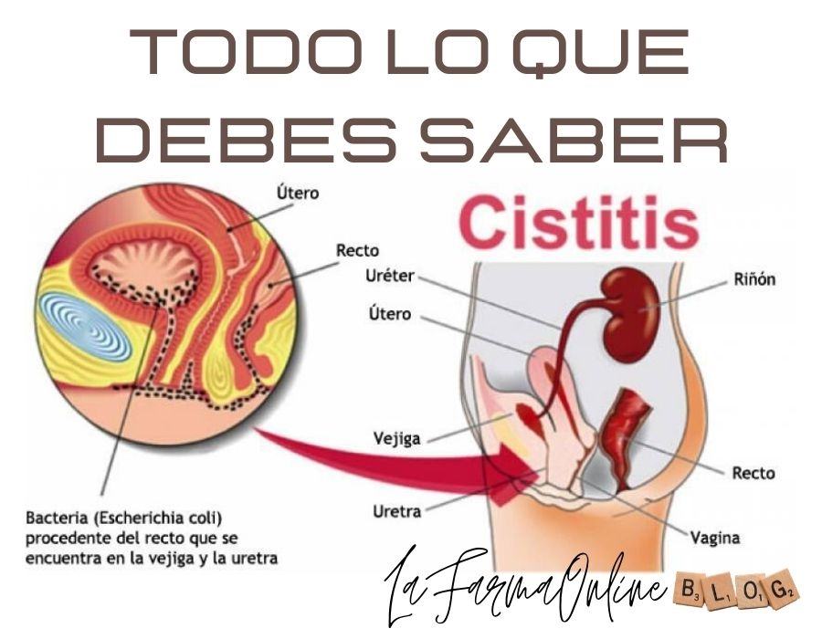 Cetosis cistitis